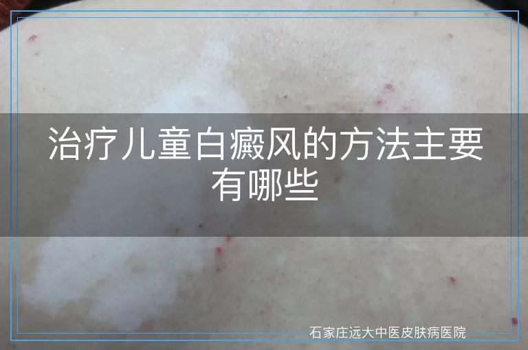 治疗儿童白癜风的方法主要有哪些