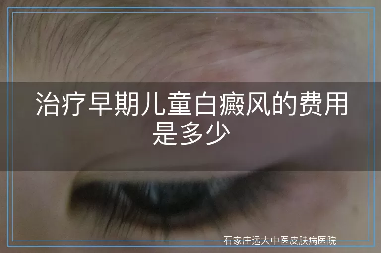 治疗早期儿童白癜风的费用是多少
