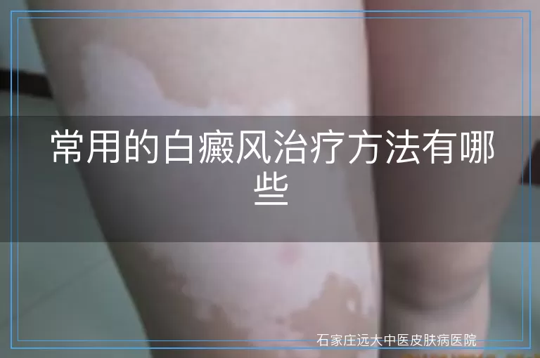常用的白癜风治疗方法有哪些