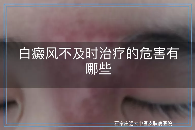 白癜风不及时治疗的危害有哪些