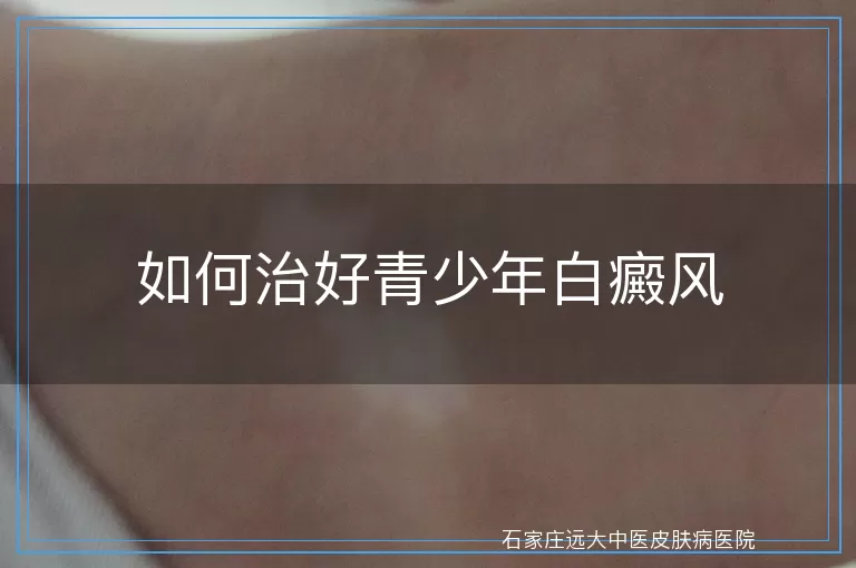 如何治好青少年白癜风