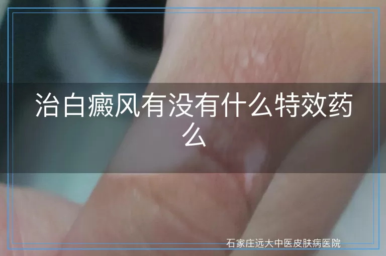 治白癜风有没有什么特效药么