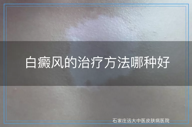 白癜风的治疗方法哪种好