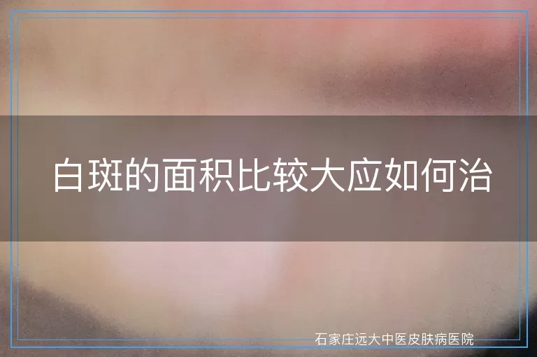 白斑的面积比较大应如何治