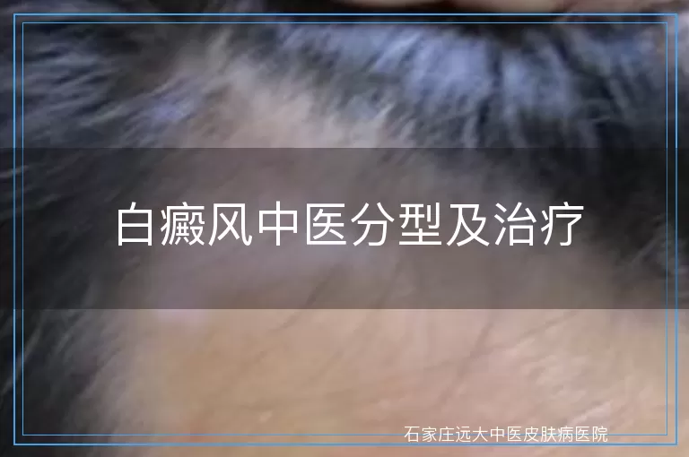 白癜风中医分型及治疗