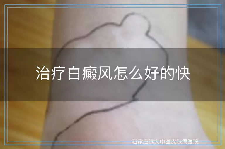 治疗白癜风怎么好的快