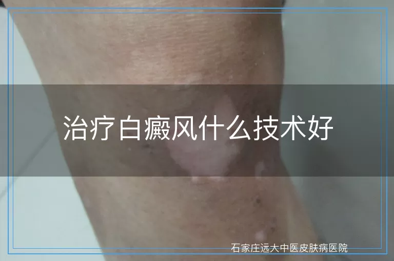 治疗白癜风什么技术好