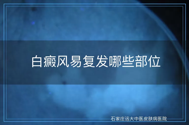 白癜风易复发哪些部位