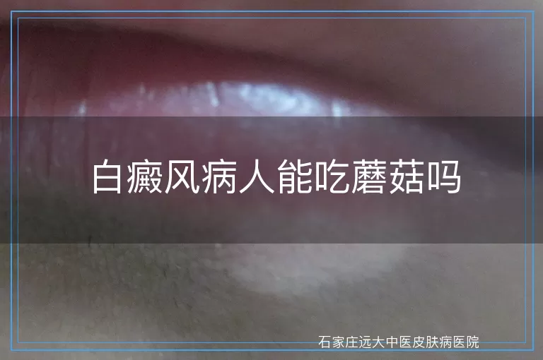 白癜风病人能吃蘑菇吗