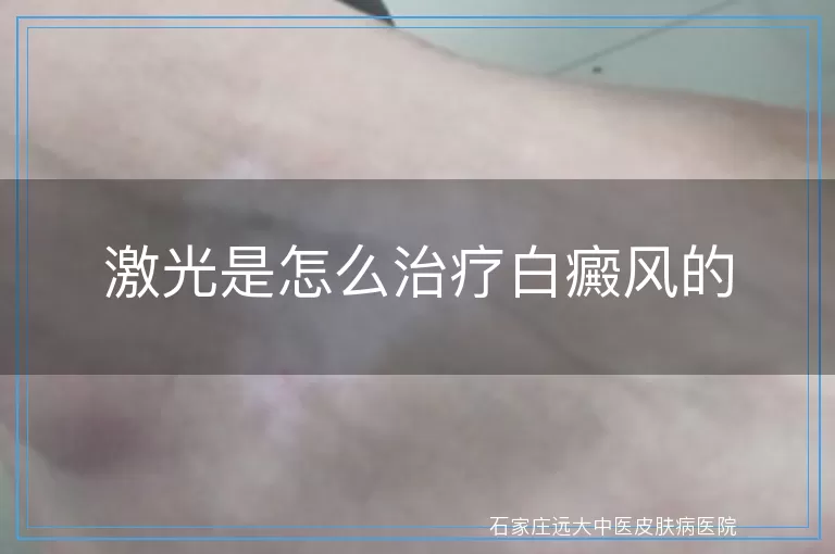 激光是怎么治疗白癜风的