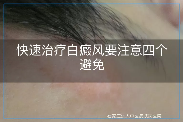 快速治疗白癜风要注意四个避免