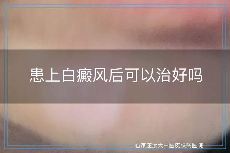 患上白癜风后可以治好吗