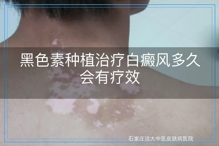 黑色素种植治疗白癜风多久会有疗效