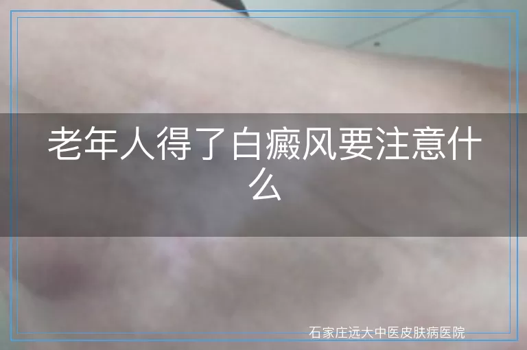 老年人得了白癜风要注意什么
