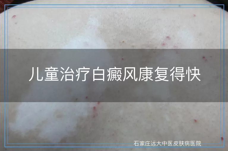 儿童治疗白癜风康复得快