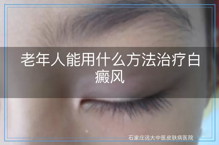 老年人能用什么方法治疗白癜风