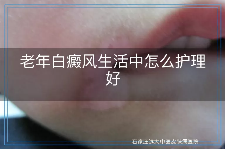 老年白癜风生活中怎么护理好