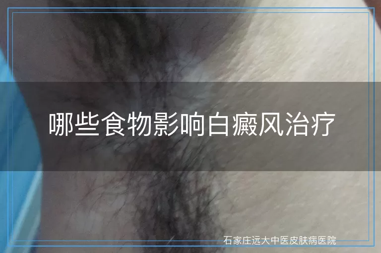 哪些食物影响白癜风治疗