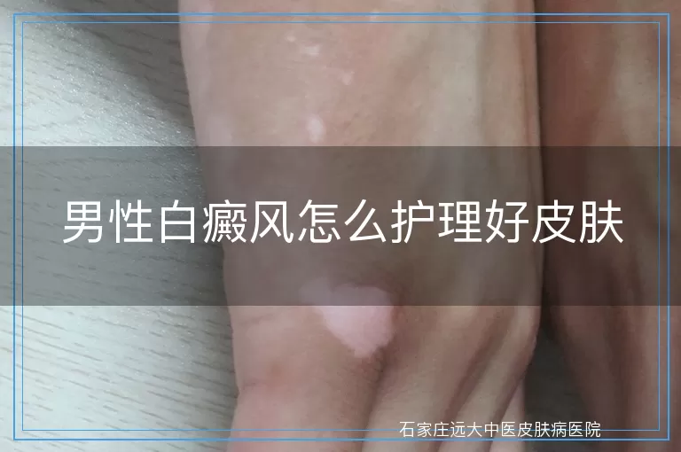 男性白癜风怎么护理好皮肤