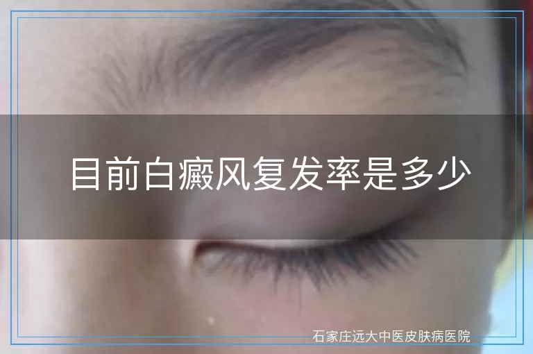目前白癜风复发率是多少