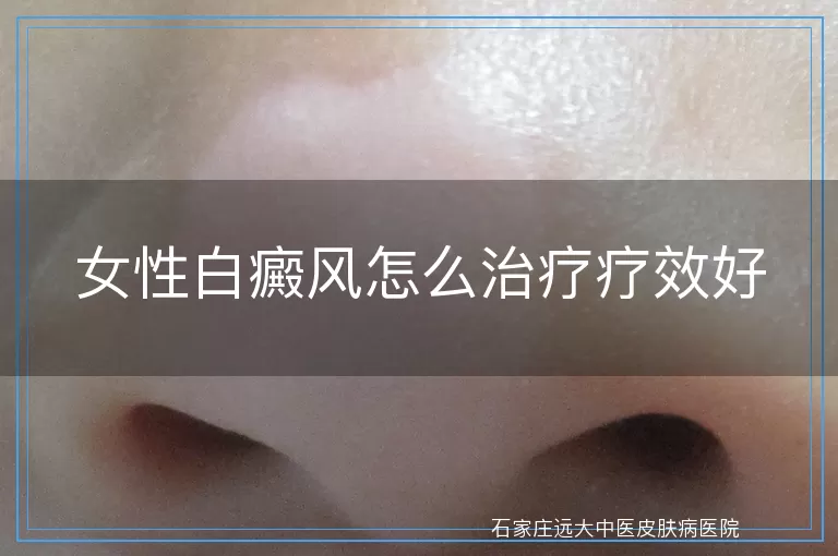 女性白癜风怎么治疗疗效好