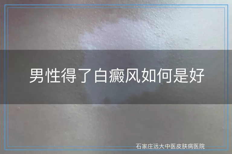男性得了白癜风如何是好