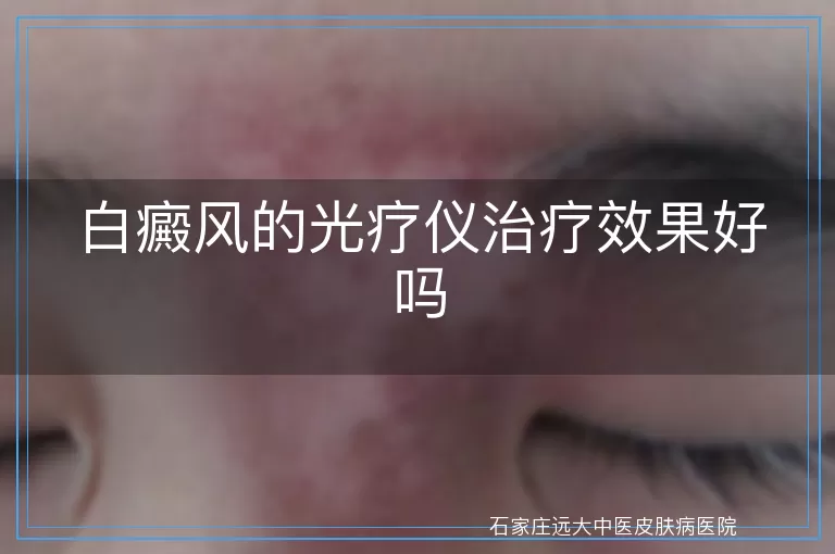 白癜风的光疗仪治疗效果好吗