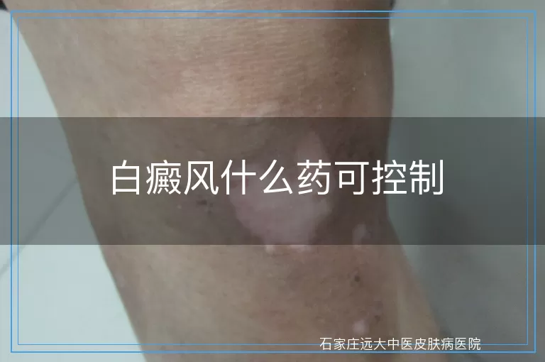白癜风什么药可控制
