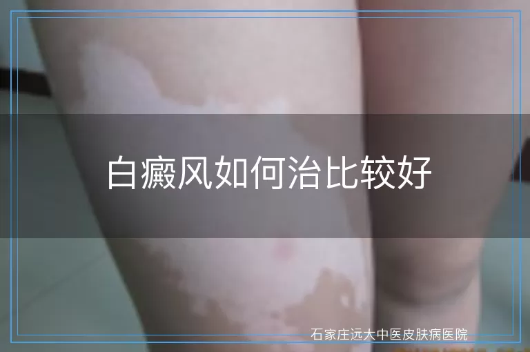 白癜风如何治比较好