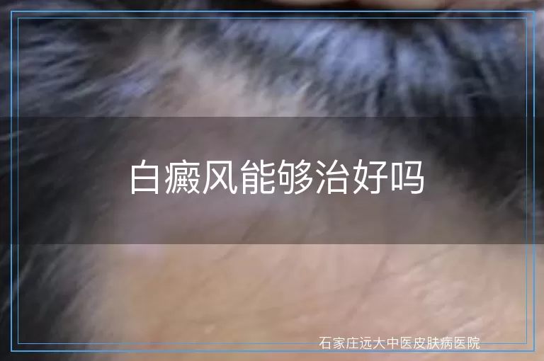 白癜风能够治好吗