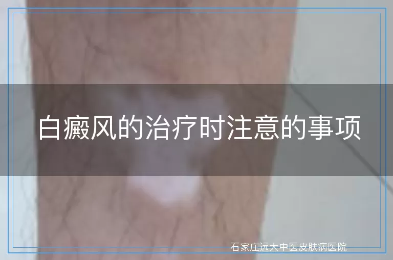 白癜风的治疗时注意的事项