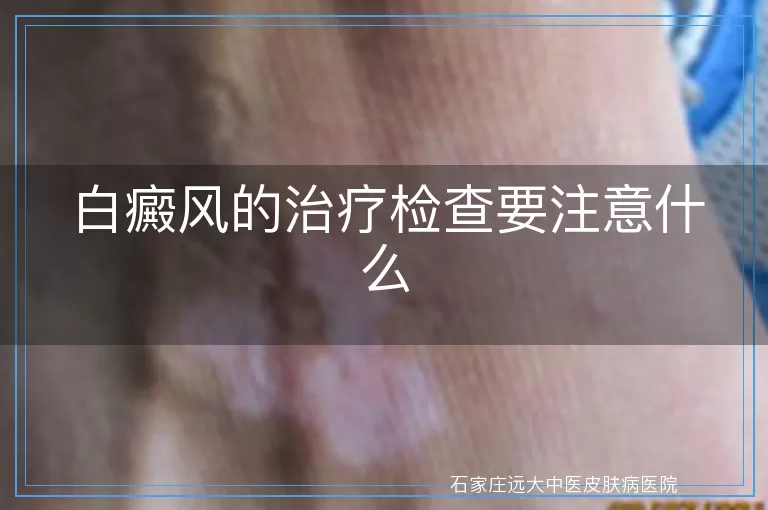 白癜风的治疗检查要注意什么
