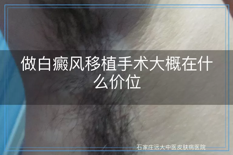 做白癜风移植手术大概在什么价位