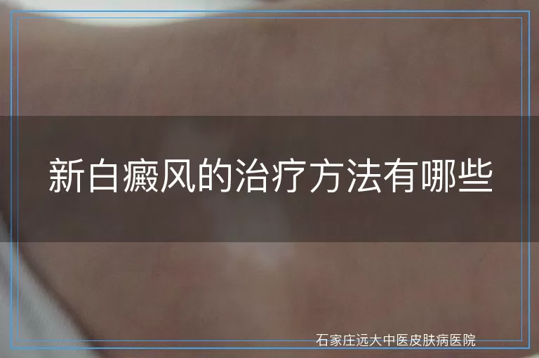 新白癜风的治疗方法有哪些