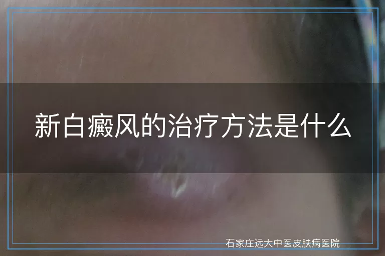 新白癜风的治疗方法是什么