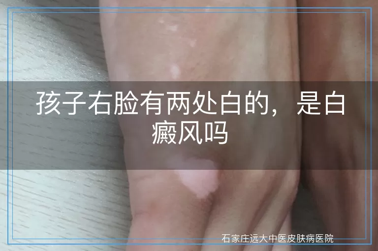 孩子右脸有两处白的，是白癜风吗