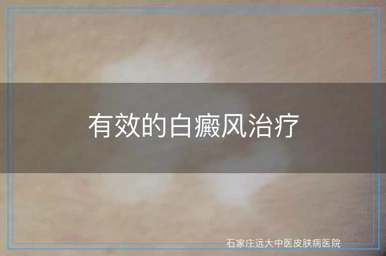 有效的白癜风治疗