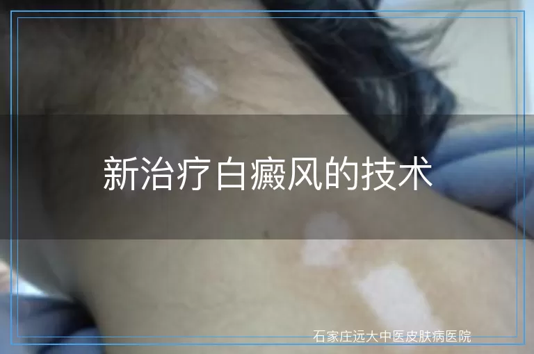 新治疗白癜风的技术