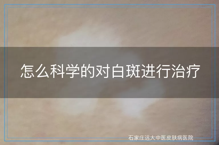 怎么科学的对白斑进行治疗