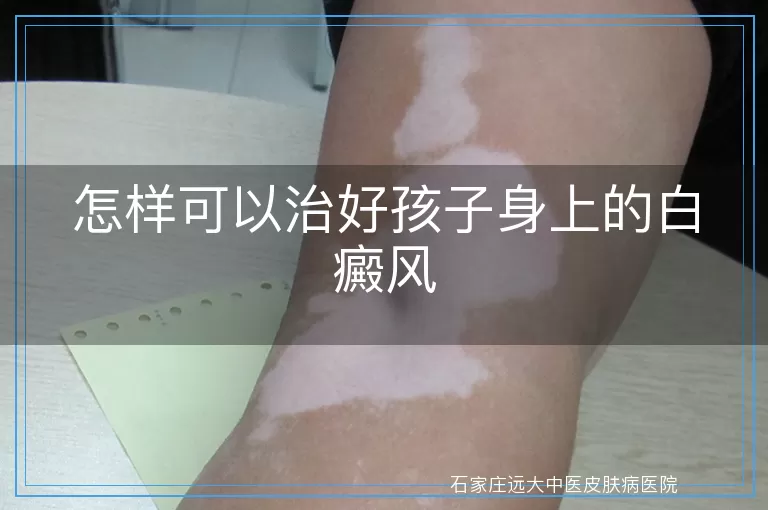 怎样可以治好孩子身上的白癜风