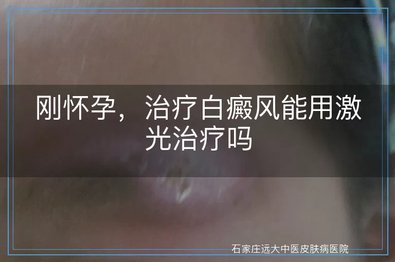 刚怀孕，治疗白癜风能用激光治疗吗