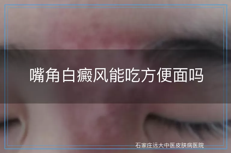 嘴角白癜风能吃方便面吗