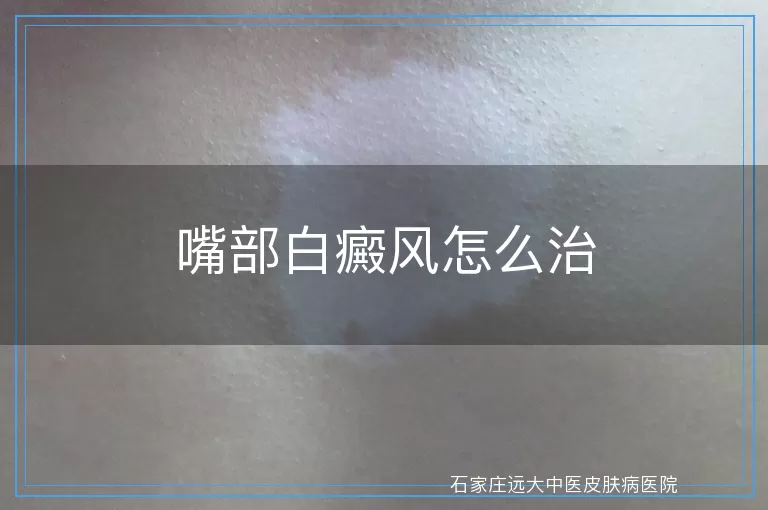 嘴部白癜风怎么治
