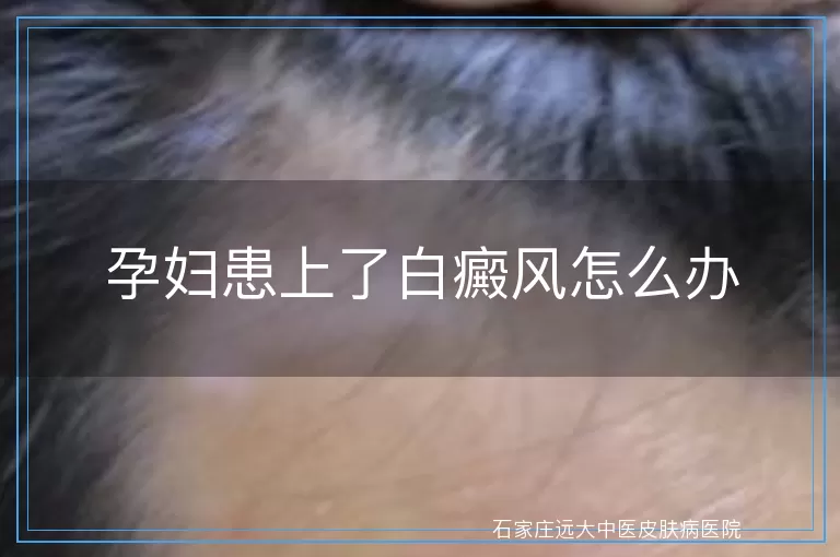 孕妇患上了白癜风怎么办