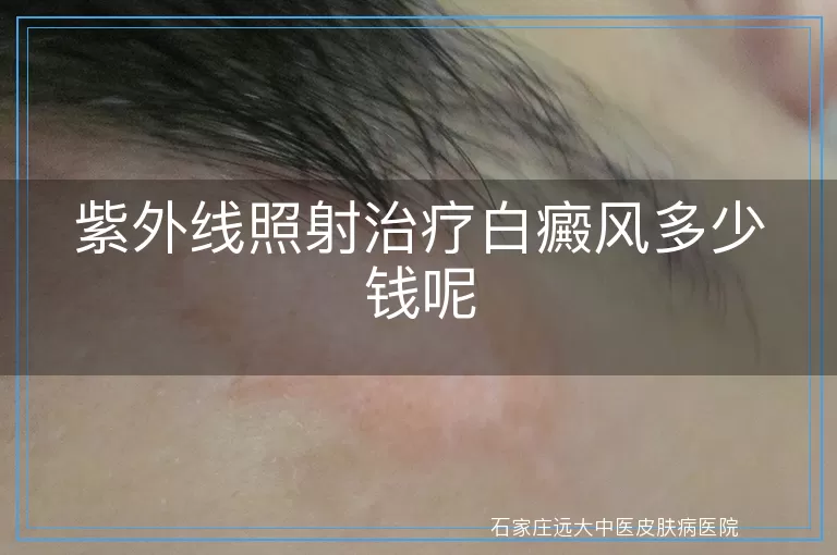 紫外线照射治疗白癜风多少钱呢