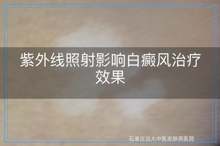 紫外线照射影响白癜风治疗效果