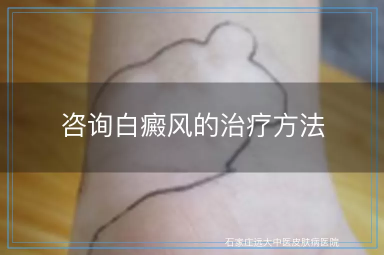 咨询白癜风的治疗方法