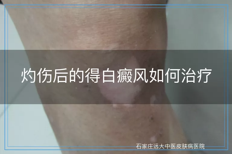 灼伤后的得白癜风如何治疗
