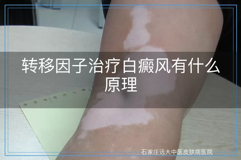转移因子治疗白癜风有什么原理