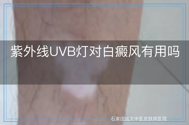 紫外线UVB灯对白癜风有用吗